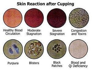 Six Reactions After Cupping Six Reactions After Cupping | Fighting Arts Health Lab