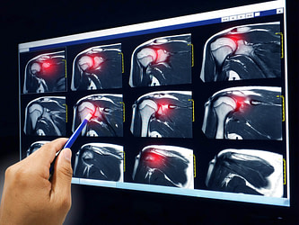 Rotator Cuff Injury XRay Rotator Cuff Injury XRay | Fighting Arts Health Lab