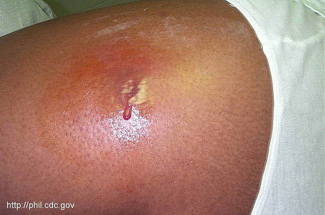 Staph Infection Abscess Staph Infection Abscess
