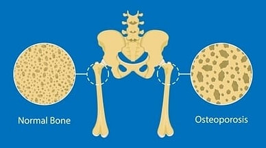 MMA Metabolism Weakened Bones MMA Metabolism Weakened Bones