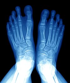 Foot Injury Diagnosis Foot Injury Diagnosis