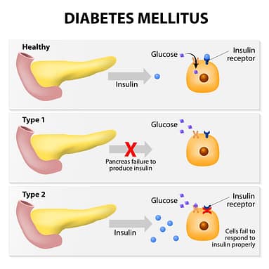 Diabetes Types Diabetes Types | Fighting Arts Health Lab