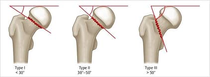 Combat Arts Thigh Injuries Classification Combat Arts Thigh Injuries Pauwel Classification | Fighting Arts Health Lab