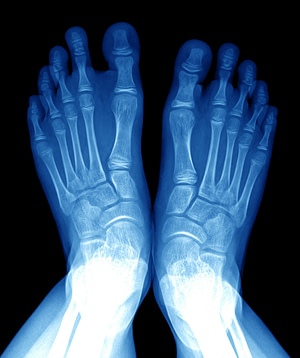 Foot Injury Diagnosis Foot Injury Diagnosis