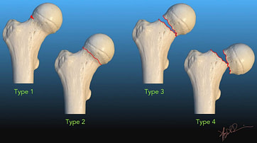 Combat Arts Thigh Injuries garden fracture classifications Combat Arts Thigh Injuries Garden Fracture Classifications | Fighting Arts Health Lab