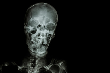 Head Injury XRay Head Injury XRay | Fighting Arts Health Lab