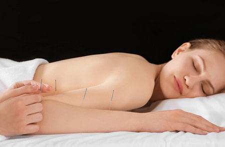 Bicep Acupuncture Treatment Bicep Injury Treatment | Fighting Arts Health Lab
