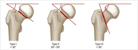 Combat Arts Thigh Injuries Classification Combat Arts Thigh Injuries Pauwel Classification | Fighting Arts Health Lab