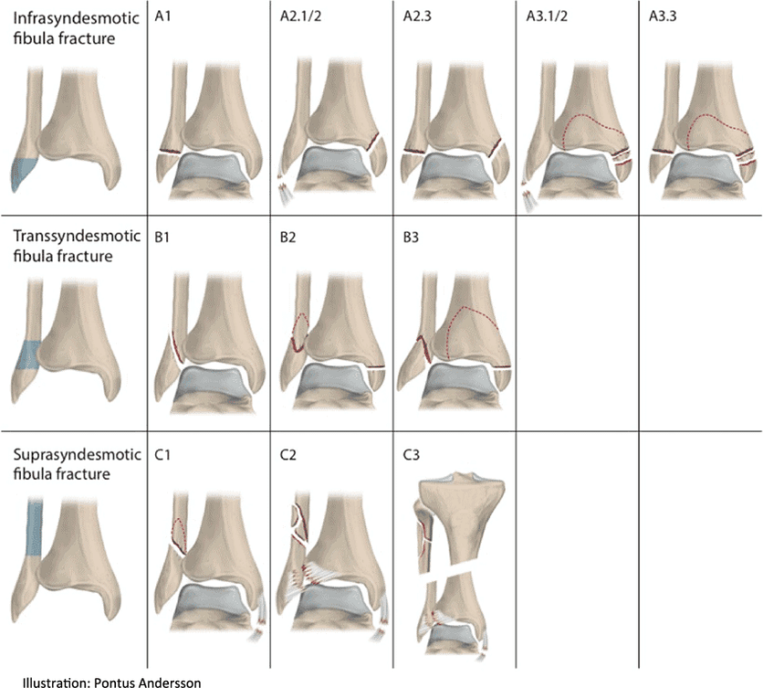 Combat Arts Thigh Injuries The-AO-OTA-classification-of-ankle-fractures Combat Arts Thigh Injuries AO OTA Fractures Classification | Fighting Arts Health Lab