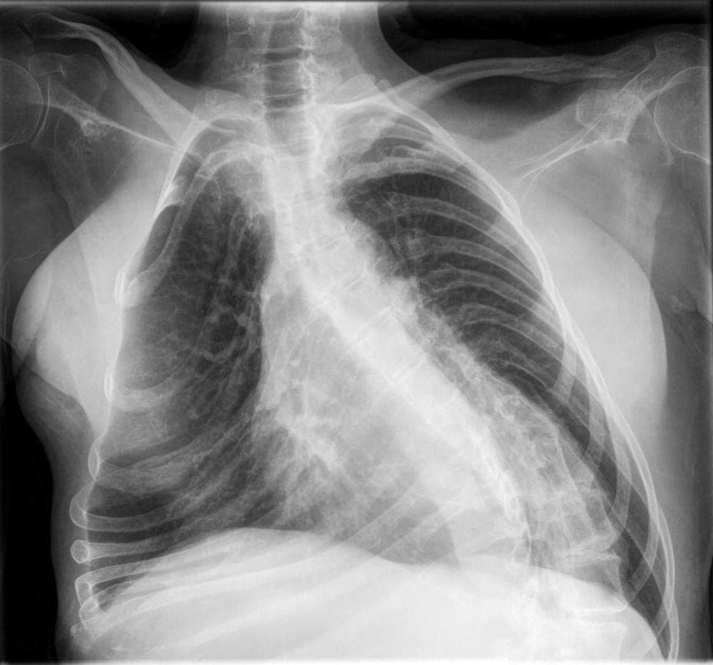 Lung Atrophy Lung Atrophy | Fighting Arts Health Lab