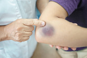Elbow Bruise Diagnosis Elbow Bruise Diagnosis