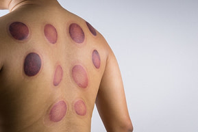 Cupping Therapy