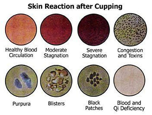 Six Reactions After Cupping Six Reactions After Cupping | Fighting Arts Health Lab