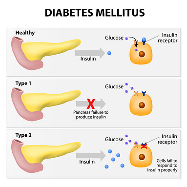 Diabetes Types | Fighting Arts Health Lab