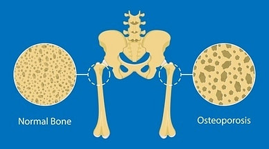 MMA Metabolism Weakened Bones MMA Metabolism Weakened Bones