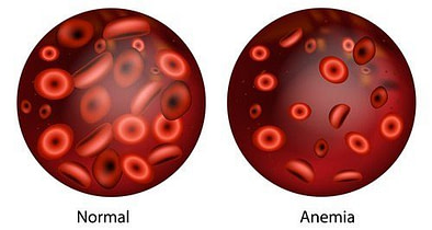 MMA Anemia Problems MMA Anemia Problems