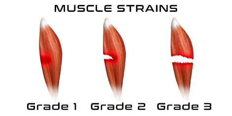 Grades of Muscle Injury Grades of Muscle Injury | Fighting Arts Health Lab