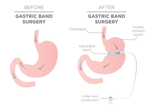Gastric Band Surgery Gastric Band Surgery | Fighting Arts Health Lab