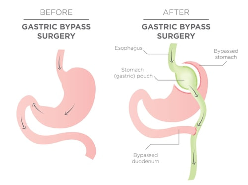 Gastric Bypass Surgery Gastric Bypass Surgery | Fighting Arts Health Lab
